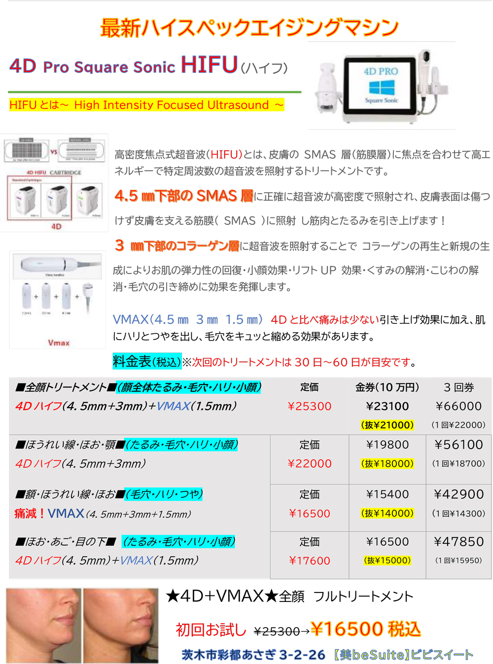 4D HIFU(ハイフ)