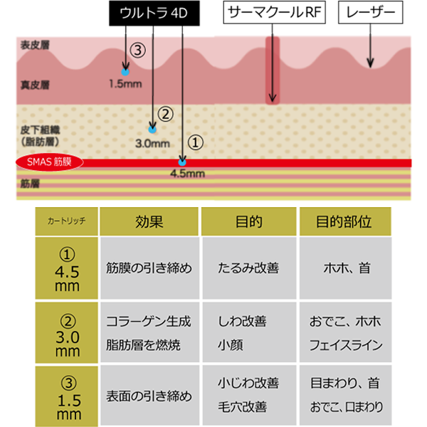 4D HIFUハイフ